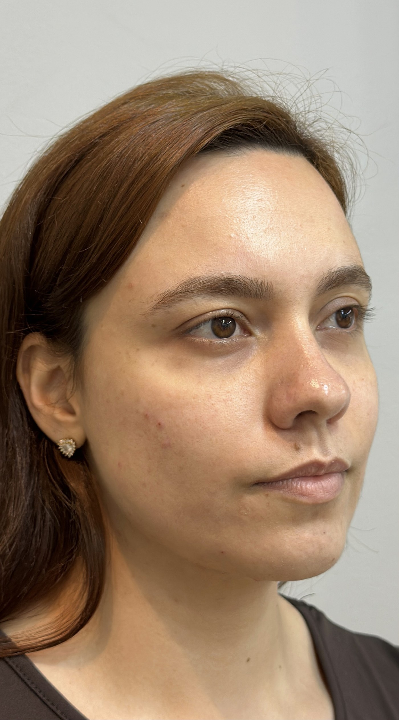 Harmonização facial, antes