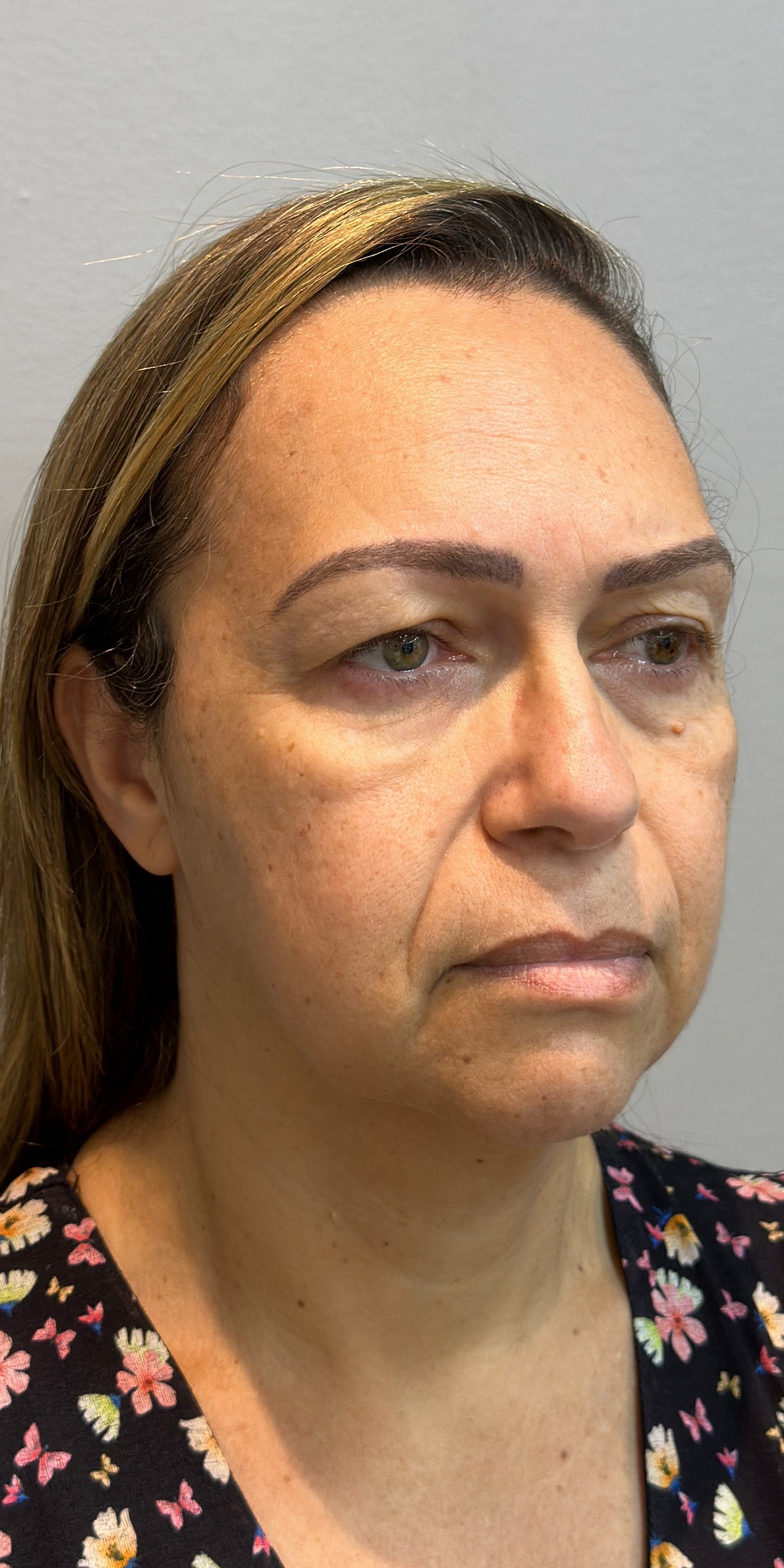 Rejuvenescimento facial, antes