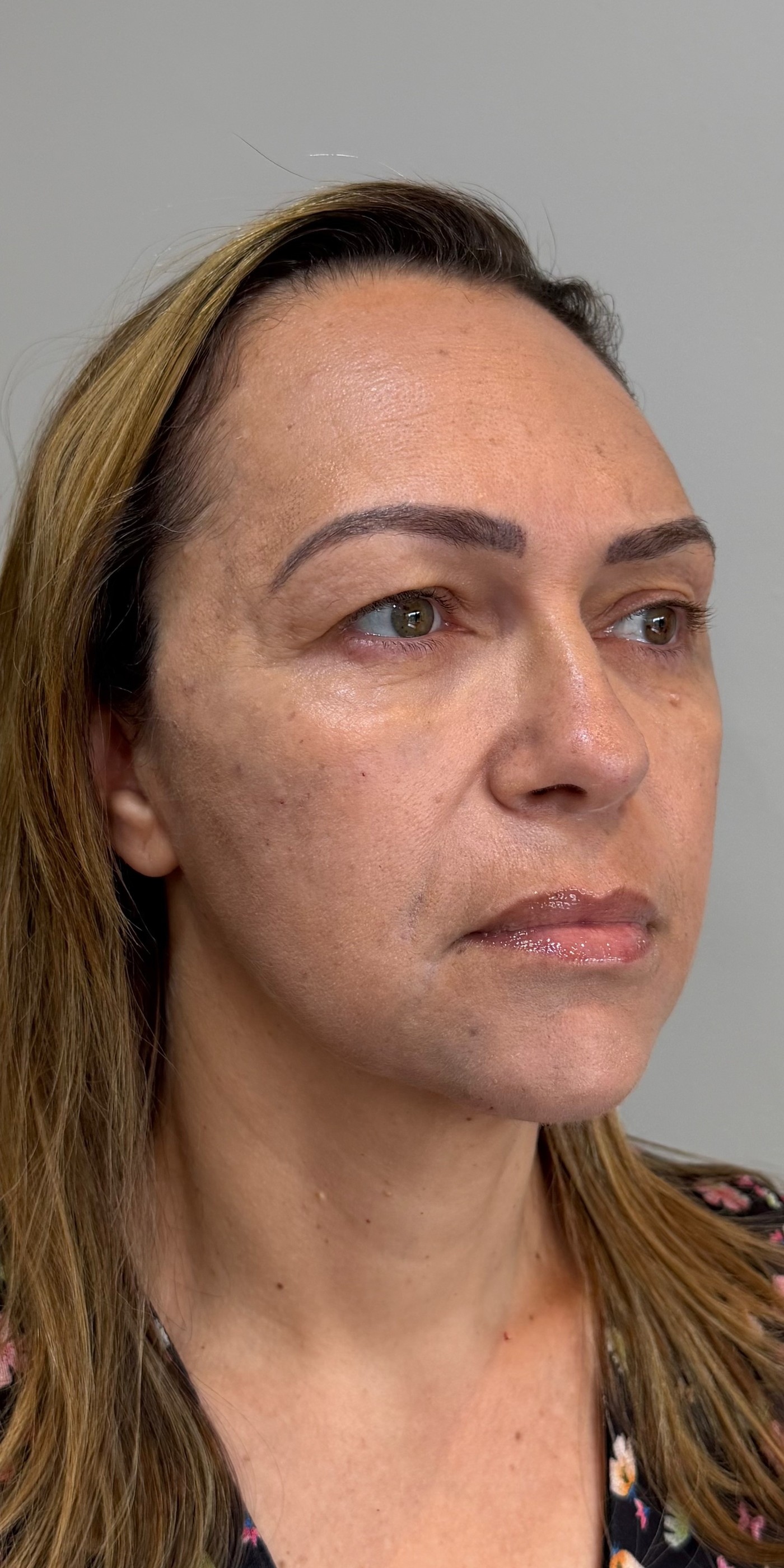 Rejuvenescimento facial, depois