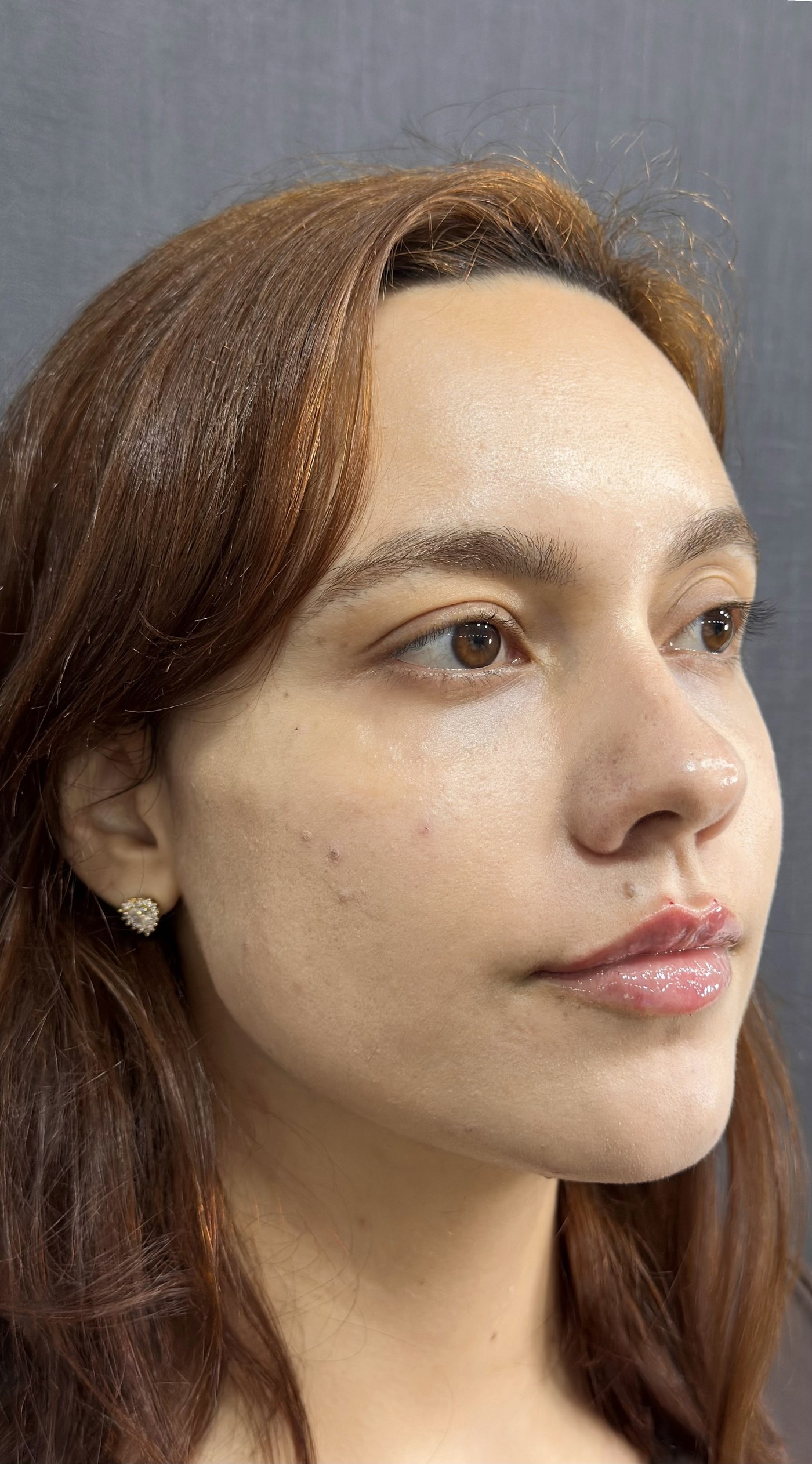 Harmonização facial, depois